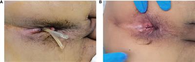 Trans-Anastomotic Drainage Tube Placement After Hand-Sewn Anastomosis in Patients Undergoing Intersphincteric Resection for Low Rectal Cancer: An Alternative Drainage Method